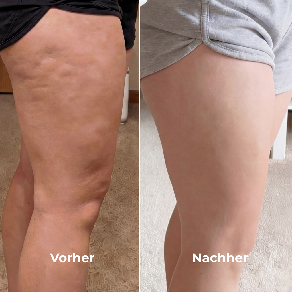 Straffende Anti-Cellulite Körperlotion mit Nocturshape™ auf Oberschenkeln, Vorher-Nachher-Bilder, sichtbare Reduktion nach 4 Wochen